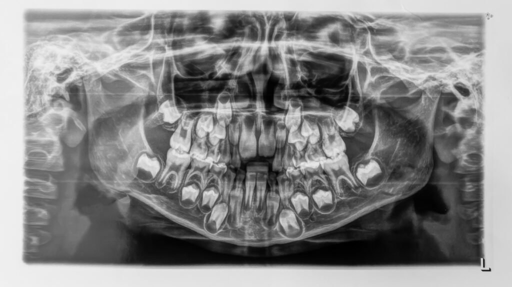 OPT radiograph of deciduous teeth